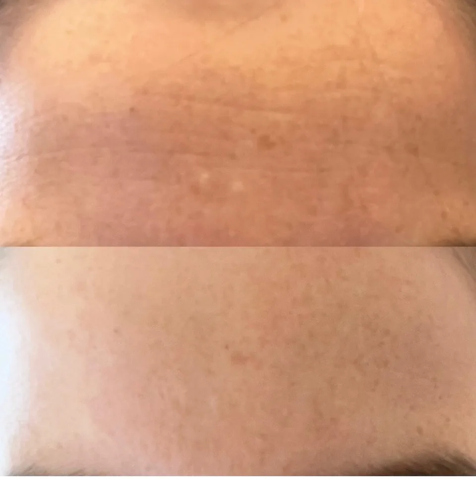 Foto 4 van product-emmagen-ageless-mask-result.webp
